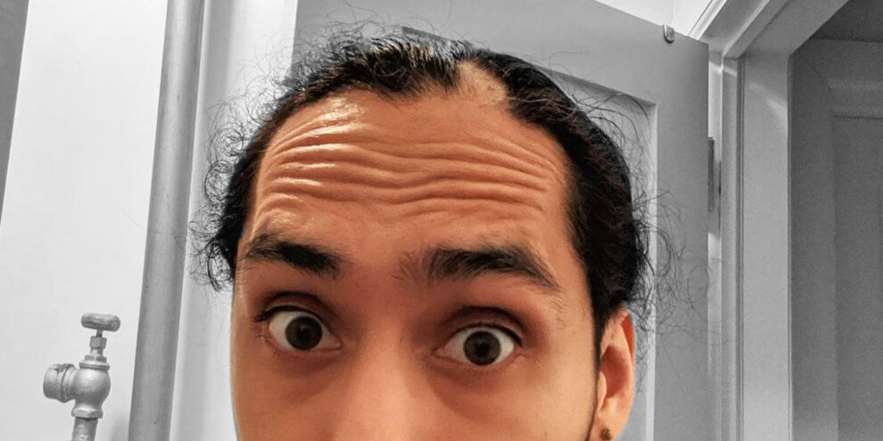 Alopecia Experience with Steven Jimenez