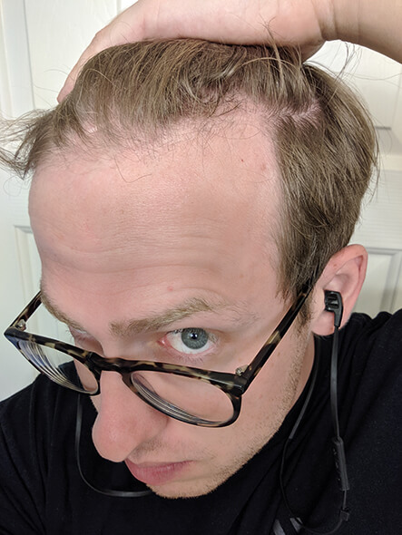 Chuck holds his hair to the side so you can see the partially grown, partially broken baby hairs…a serious sign he is going to deal with hair loss.