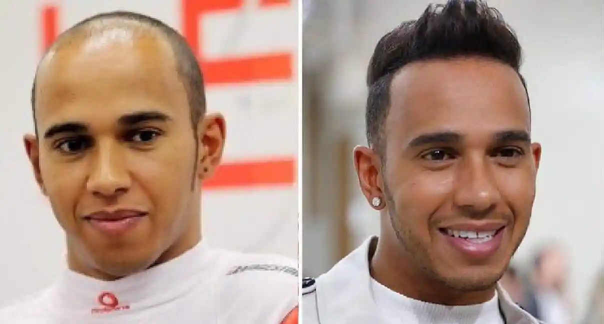 Lewis Hamilton on the left balding and then with his hair grown back on the right